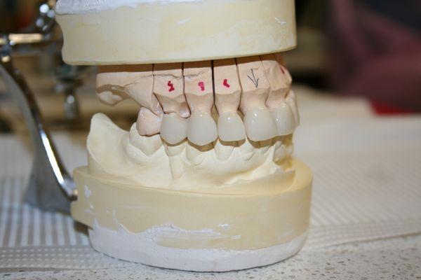 Veneers