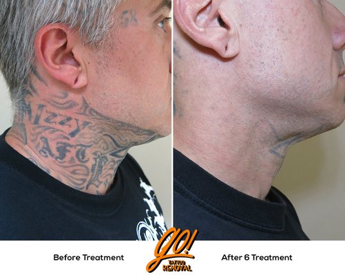 Neck and throat tattoos near full removal after 6 treatments.