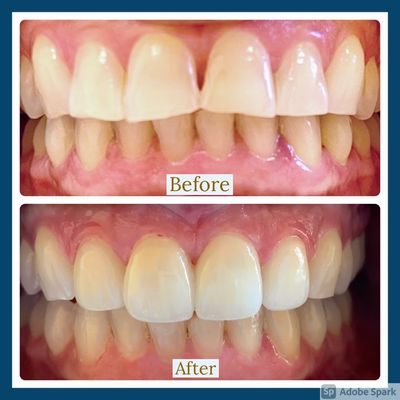 Veneers.
Happy patient
Cosmetic Dentist
Straight teeth