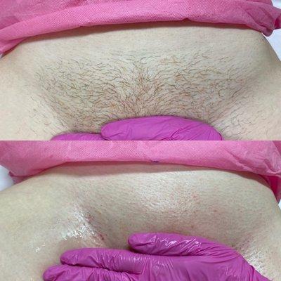 Before and After a Sugar Full Bikini Hair Removal