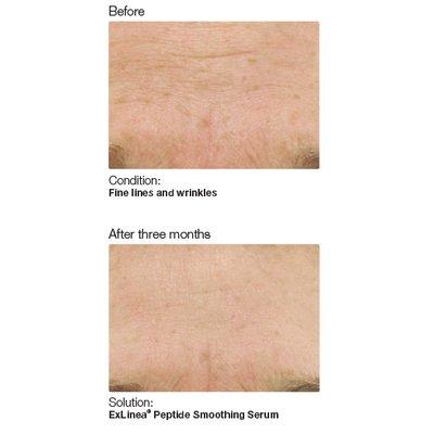 PCA Peels for Visible Aging and Hyperpigmentation