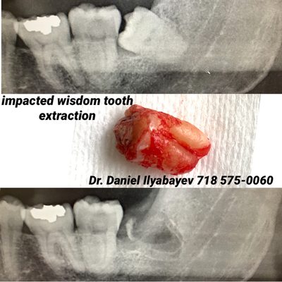 Impacted wisdom tooth extraction 718 575-0060 VIP Dental Care