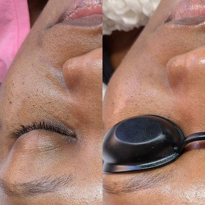 dermaplane facial before (left) and after