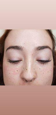 How cute are these freckles?! They will heal to a soft natural finish.