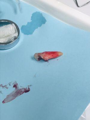 My extracted tooth!