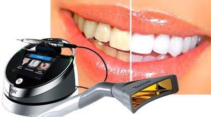 Advance Biolase Laser Whitening