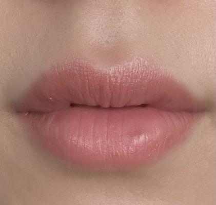 Beautiful Korean Lips  injections. Second day post treatment.