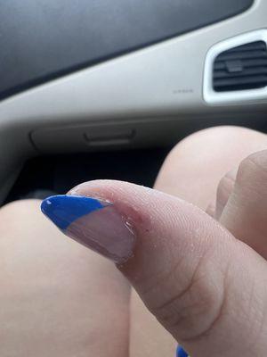 Ripped the skin off my finger