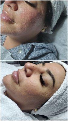 Come and experience  the microdermabrasion  treatment. This procedure  helps to smooth  your skin and exfoliate.