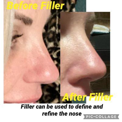 Nose Augmentation