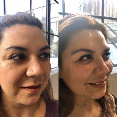 Before and after of filler to the cheeks