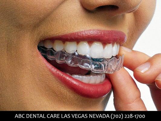 Invisalign Las Vegas