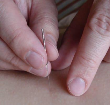 Acupuncturist Casey Lewis, MSAOM, LAc inserting needles into a patient.