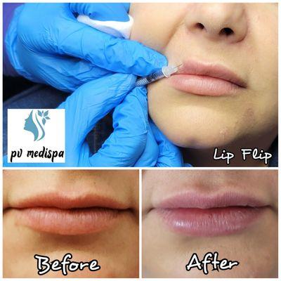 Xeomin (Botox) Lip Flip