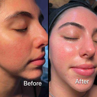 Facial for Rosacea prone Skin. We can make a big improvement since the first session