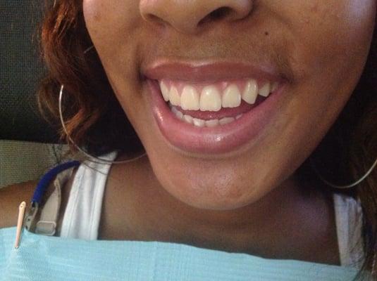 Client results after teeth whitening