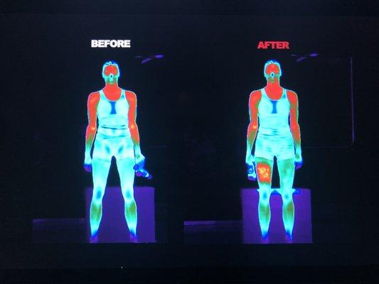 Blood flow before and after a Hypervolt Treatment