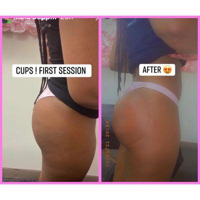 This client first session, amazing results no downtime, no pain, and no surgery.  Contact us today!