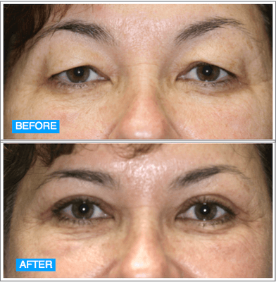 Before & After Eyelid Surgery