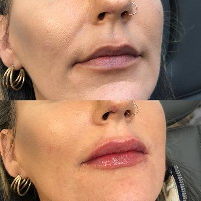 Before and After Lip Filler