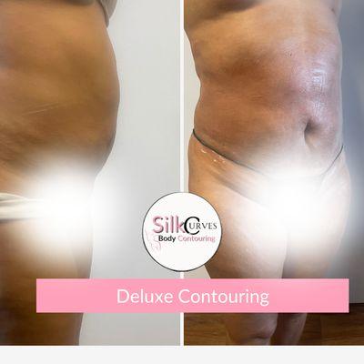 Silk Curves Body Contouring