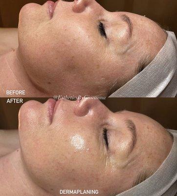 #BasicFacial + #Dermaplaning