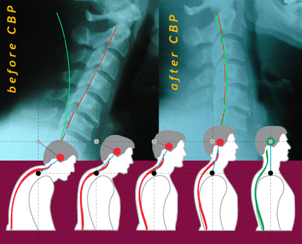 Chiropractic BioPhysics (or CBP®) Technique emphasizes optimal posture and spinal alignment as the primary goals of chiropractic