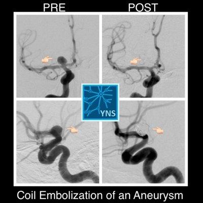 Minimally-Invasive Neurosurgery: Successful coil embolization of a large brain aneurysm.