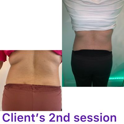 Body cavitation results just after 2 sessions with me.