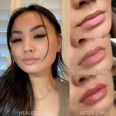 Healed 2 mL Needle-less Lip Filler