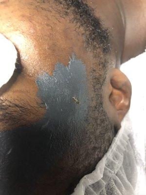 Charcoal mask at work! Purifying and detoxifying the skin. Schedule for our treatment if you suffer with oily skin.