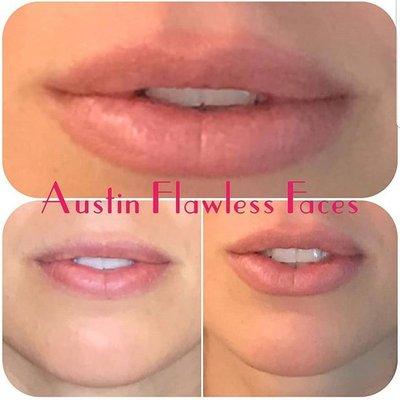 Lip Enhancement