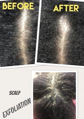 Scalp exfoliation helps to remove dead skin cells from the scalp, as well as removing congestion from the follicles .