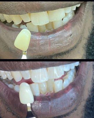 Teeth Whitening Results