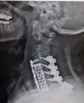 complex cervical spine reconstruction surgery