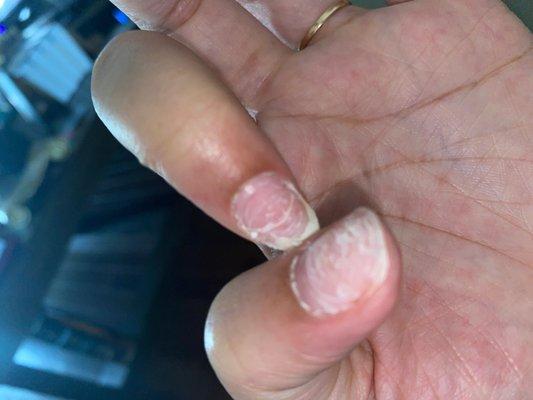 extremely painful Cracked nail