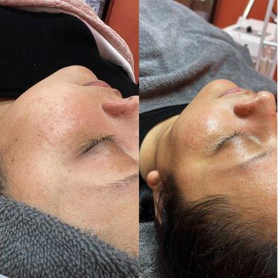 Dermaplaning