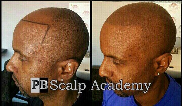 Defy hairloss with Scalp micropigmentation (SMP)