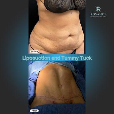 Liposuction and Tummy Tuck