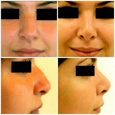 Rhinoplasty