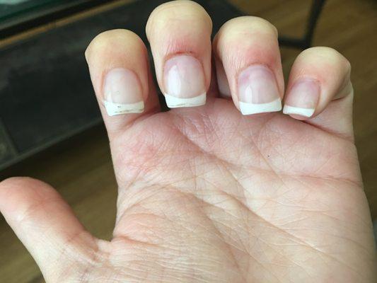 You can see where I was cut and the weird shaping on the top of my nails. Index finger is totally crooked.