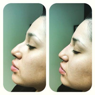 10 minutes nose job!