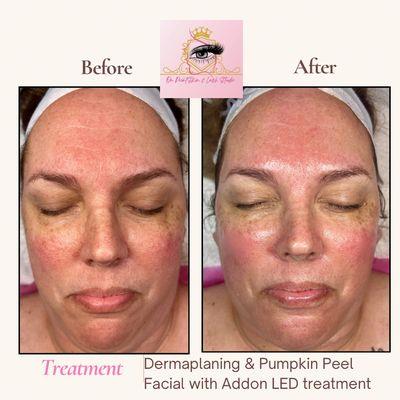 DermaPlaning & Pumpkin Peel Facial with LED Treatment addon