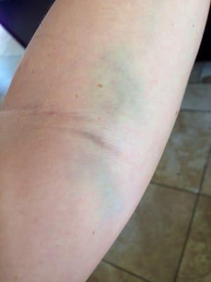 Still have this bruise on my arm after getting blood drawn two weeks ago!Only it's darker now.Same thing happened to my husband!