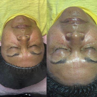 Dermaplaning