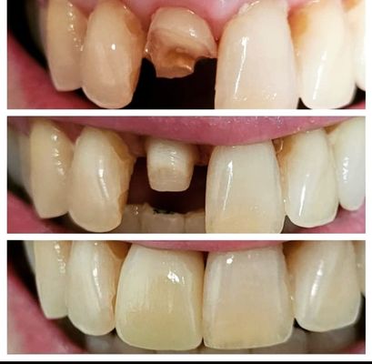 Same visit from a broken tooth to. A beautiful in office Milled crown