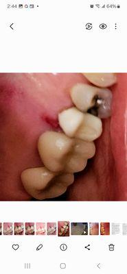 Cut to my gum between teeth #13 & #14