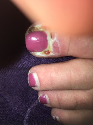 My infected mutilated toe