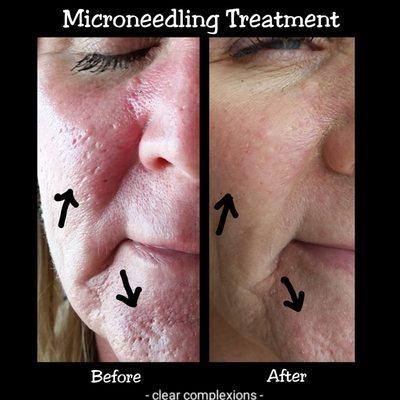 Before & After Microneedling Treatment