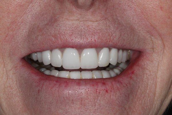 After photo of one our patients